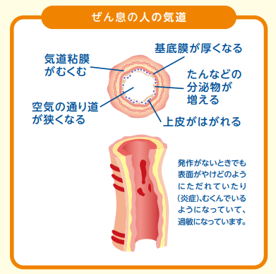 気管支喘息_図2