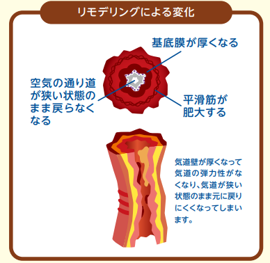 気管支喘息_図4