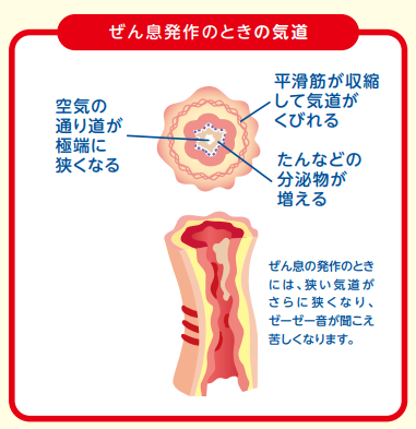 気管支喘息_図3