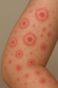 多形紅斑